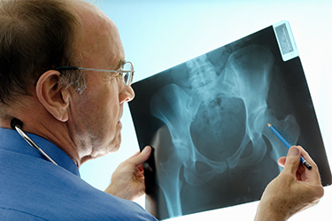 doctor reviewing hip osteoarthritis