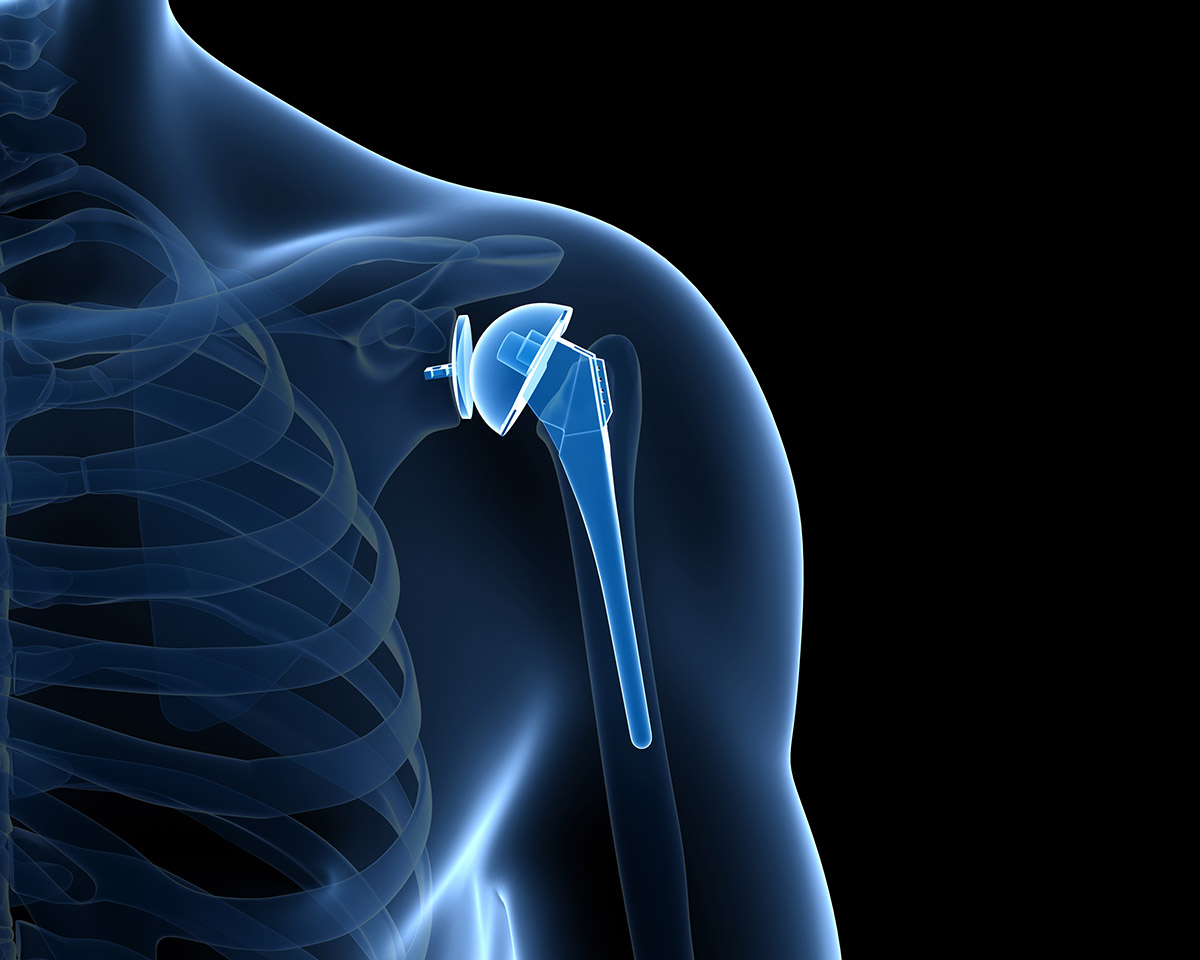 Shoulder Arthroplasty Joint Replacement Proliance Puget Sound