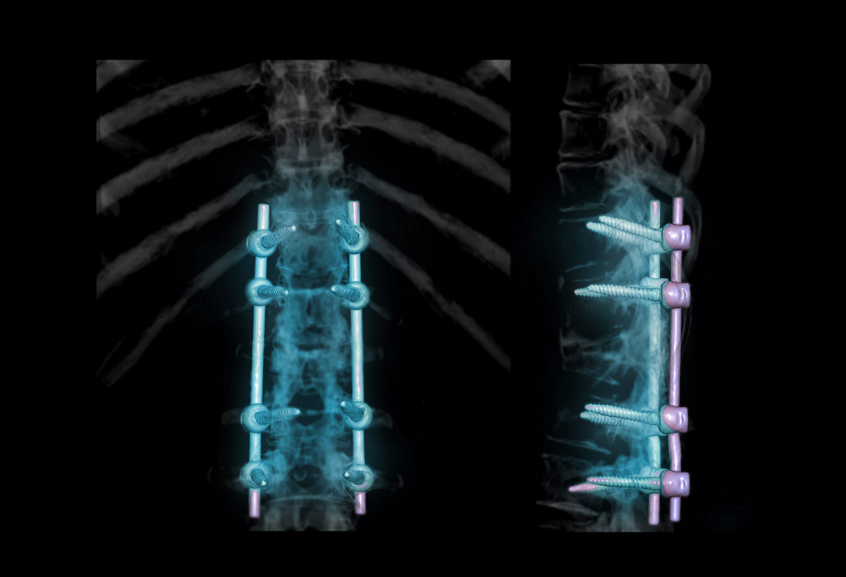 Lumbar Spine Fusion Proliance Puget Sound Orthopaedics